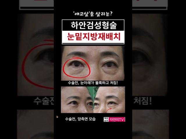 애교살보존 하안검성형술  가능할까?#눈밑지방재배치 #하안검성형재수술 #신촌성형외과 #근막초고정 #눈밑심술보 #애교살 #연세자연미성형 #홍대성형외과 #외안각고정 #은평성형외과