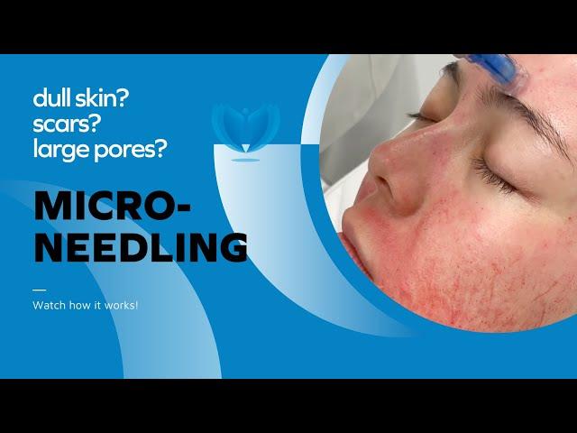 How to Treat Large Pores, Uneven Skin Texture, Pigmentation and Wrinkles - Microneedling Treatment