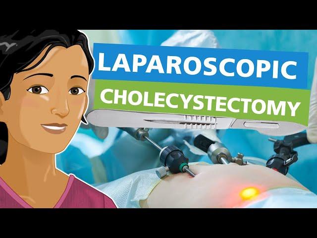 Laparoscopic Cholecystectomy