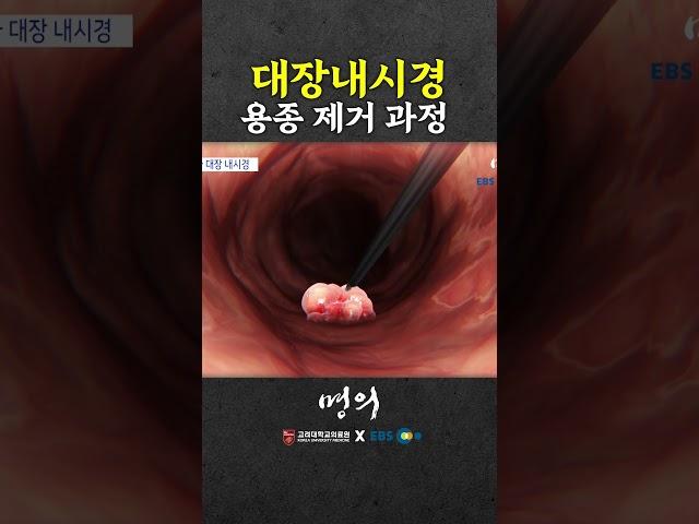What if you found a polyp during colonoscopy?