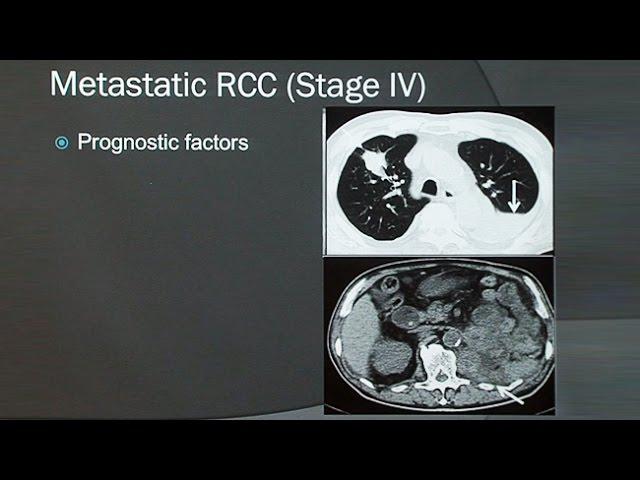 Renal Cell Carcinoma