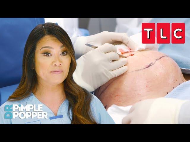 Biggest Removals Ever | Dr. Pimple Popper | TLC