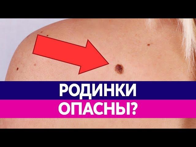 ЧЕМ ОПАСНЫ РОДИНКИ НА ТЕЛЕ? Можно ли удалять родинки?