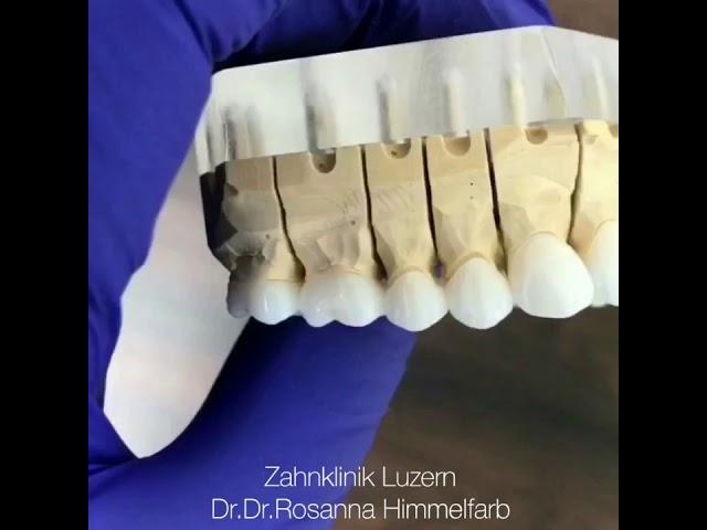 Veneers & Crowns Smilemakeover @ Zahnklinik Luzern Dr.Dr.Rosanna Himmelfarb