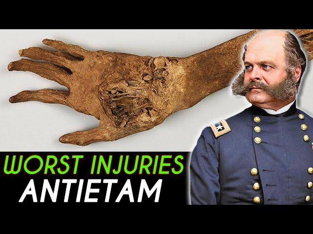 The WORST Wounds from the Battle of Antietam