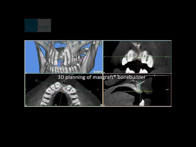 maxgraft® bonebuilder technology – customized allogenic bone block