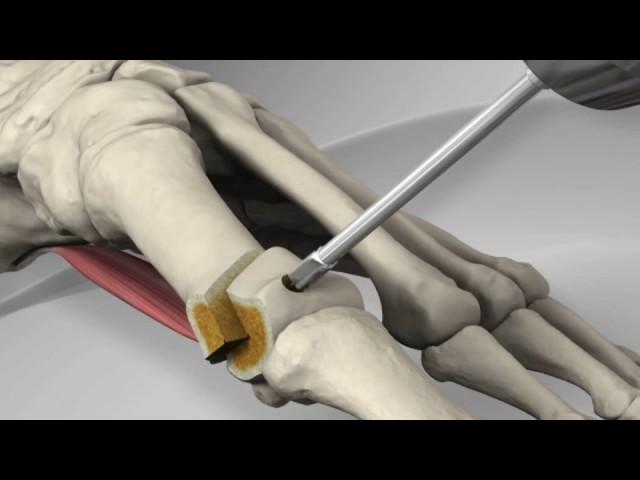 First Metatarsal Distal Chevron Osteotomy with Arthrex® LPS Screw