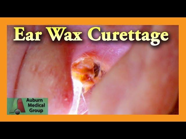 Ear Wax Removal of a Full Ear | Auburn Medical Group