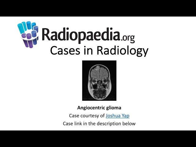 Angiocentric glioma (Radiopaedia.org) Cases in Radiology