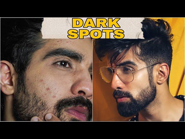 Remove DARK SPOTS NATURALLY| ACNE SCARS, HYPERPIGMENTATION, BLACK SPOTS, ACNE MARKS | HINDI| #shorts