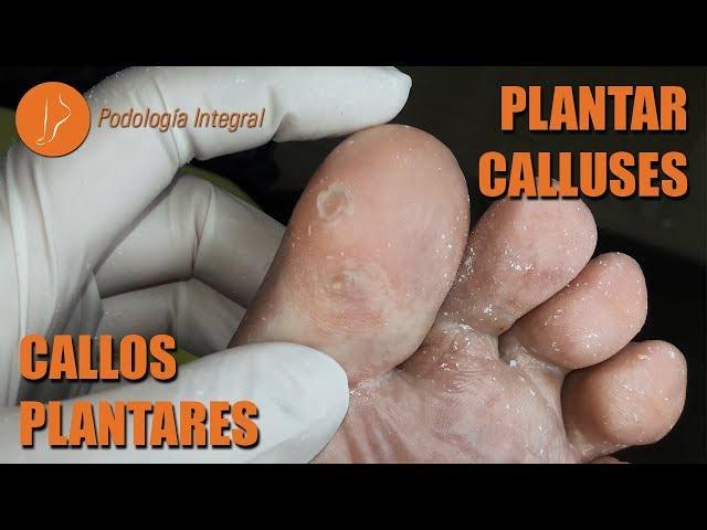 Plantar calluses [Podología Integral] #podologiaintegral