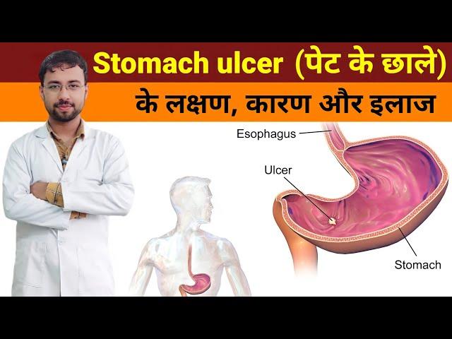 पेट के अल्सर के लक्षण, कारण और इलाज | Stomach Ulcer Causes, Symptoms & Treatment | Diet For Ulcer