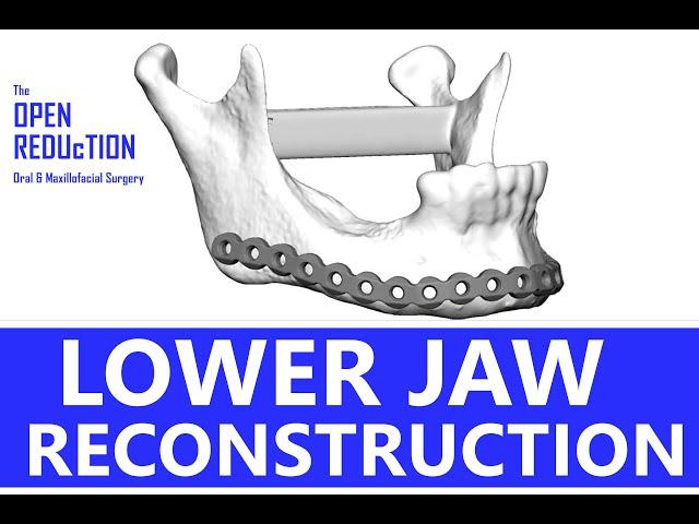 LOWER JAW RECONSTRUCTION