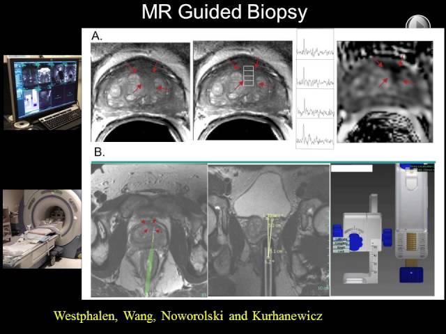 UCSF Radiology: Treatment of Prostate Cancer