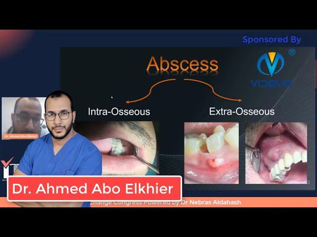 Management of Acute periapical Abcess part 1