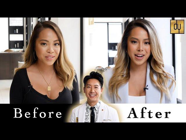 Asian Rhinoplasty | #YooNose | Pretty to Prettier® - Beverly Hills