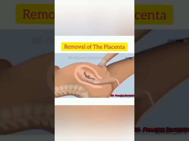 Removal Of The Placenta.......During Child Birth