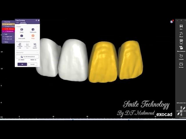 Free forme 4 unit anterior teeth Dental design By Exocad