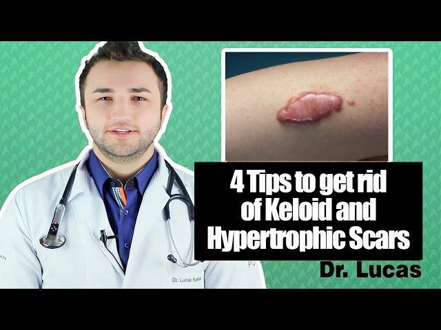 4 Tips to get rid of Keloid and Hypertrophic Scars - Dr Lucas Fustinoni Brazil