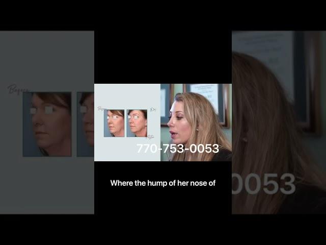 Rhinoplasty case presentation by Dr. Celeste Nagy, facial plastic surgeon.