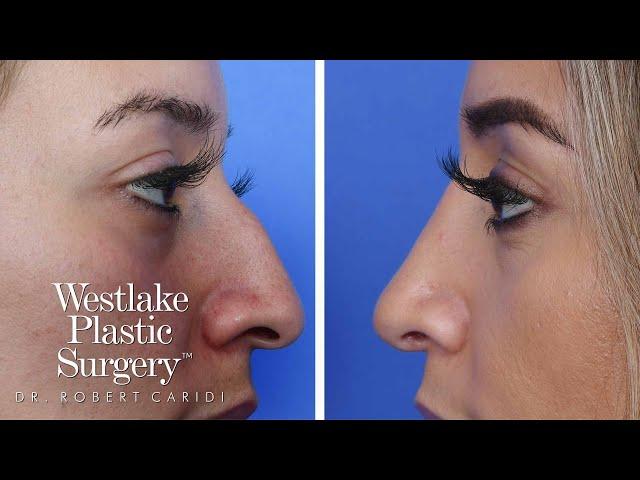 Rhinoplasty Surgery Experience - A Nose Job Before And After Journey - Rhinoplasty Recovery