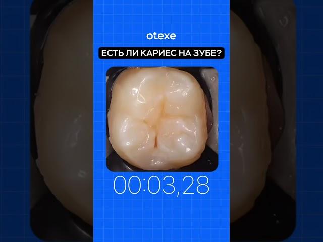 #стоматолог #стоматология #кариес #лечениекариеса #врачстоматолог #dentist