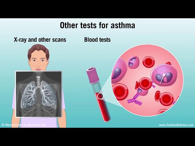 Diagnosing Asthma: Mild, Moderate, and Severe