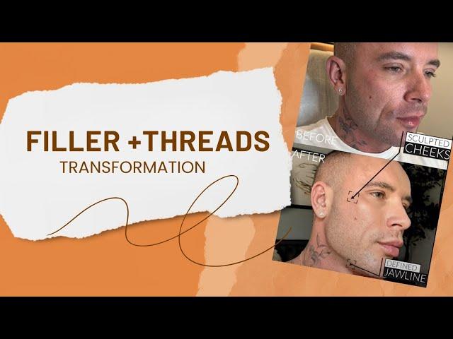 FILLER + THREADS TRANSFORMATION WITH DR. EMER