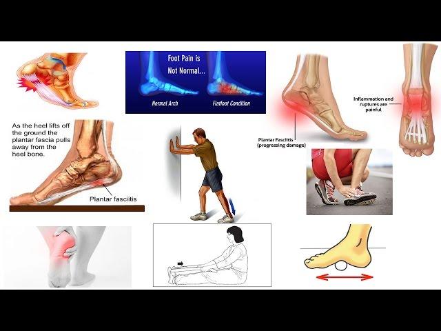 Correct Plantar Fasciitis Quickly! (Medically Proven) The Best Exercises & Stretches - Dr Mandell