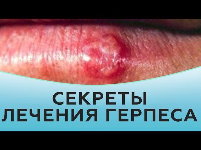 Секреты лечения герпеса