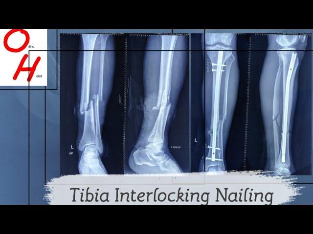 TIBIA NAILING