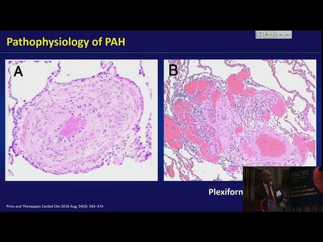 Pulmonary Hypertension: Review of Diagnosis and Treatment