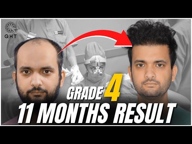 Best Hair Transplant Result 2022 | Grade 4 | Case Study | QHT Clinic Haridwar