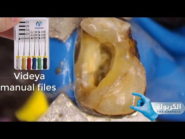 Access Cavity of upper second molar Demo simple and easy