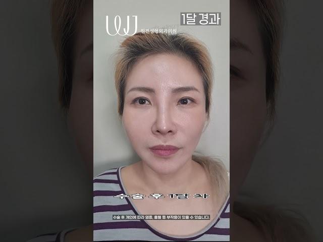 안면거상 수술전~1년 후기 #shorts