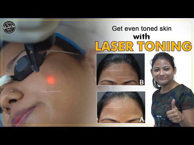 Get even toned skin with Laser Toning