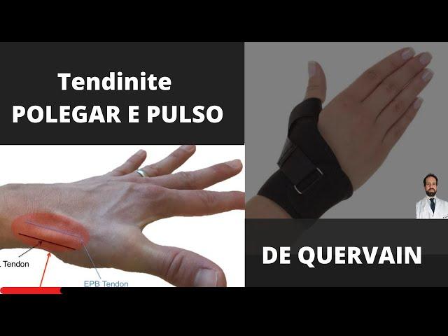 Tendinite Polegar e Pulso - De Quervain - Tratamento