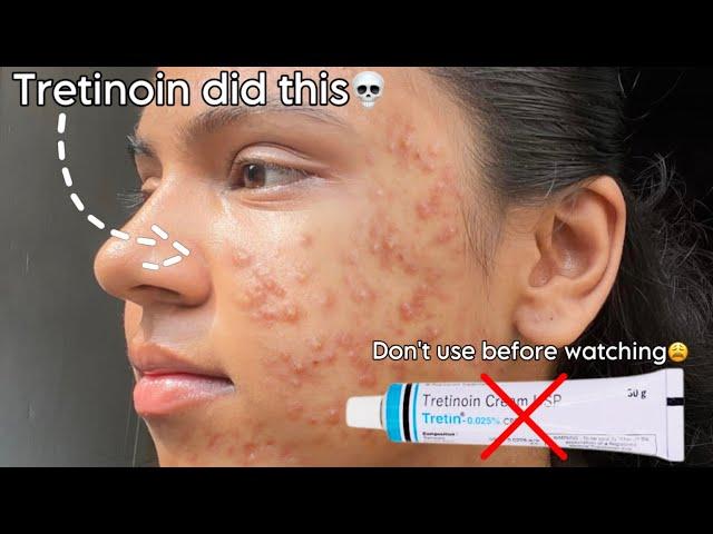 Tretinoin mistakes that ruined my skin  #tretinoin #skincare #beauty