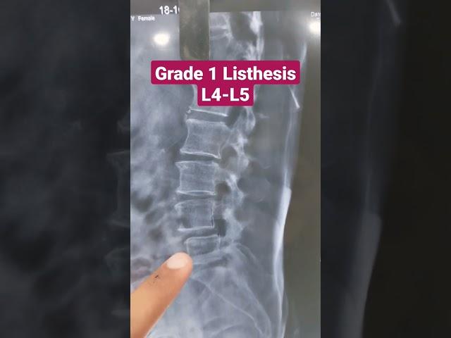 Grade 1 Listhesis L4-L5...Dr Sai Chandra