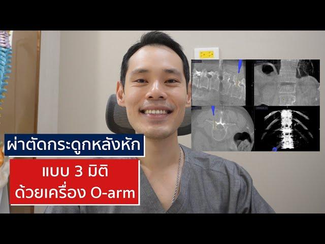 ผ่าตัดกระดูกสันหลังหัก แบบ 3 มิติ ด้วยเครื่อง O-arm | EasyDoc EP.44