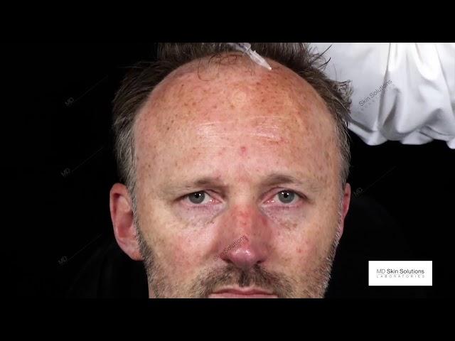 Alopecia treatment with mesoline Hair  Dr Sabine ZENKER Dermatologist Germany