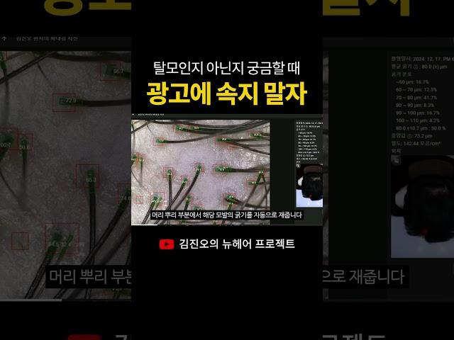 탈모인지 아닌지 궁금할 때 광고에 속지 말자