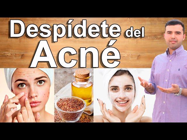 COMO CURAR EL ACNE - Como Eliminar el Acne y Sus Manchas Naturalmente y Para Siempre