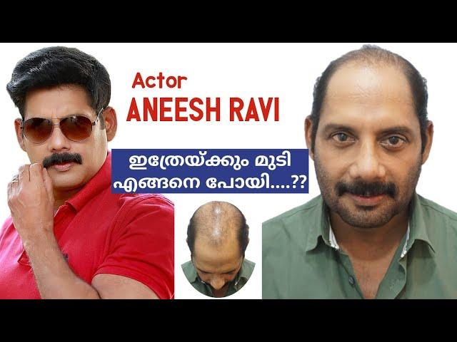 Next "Onam" with full hair Actor Aneesh Ravi, weakest Donor Area Hair Transplantation