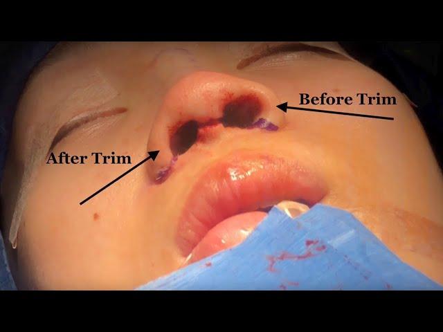 Asian Open Rhinoplasty by Doctor Kian Karimi MD, FACS