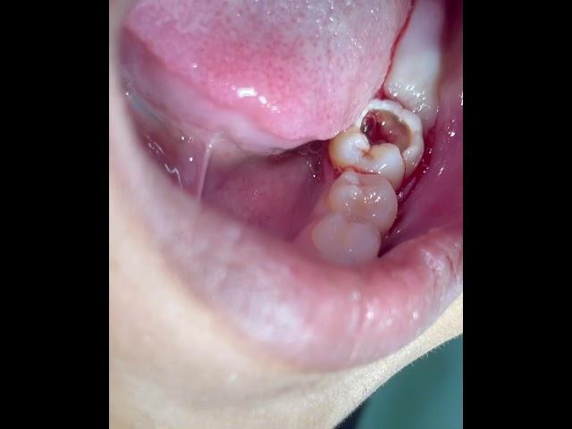 Tooth extraction(bunot sa bagang)