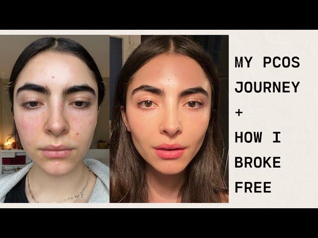 my pcos journey + how i broke free