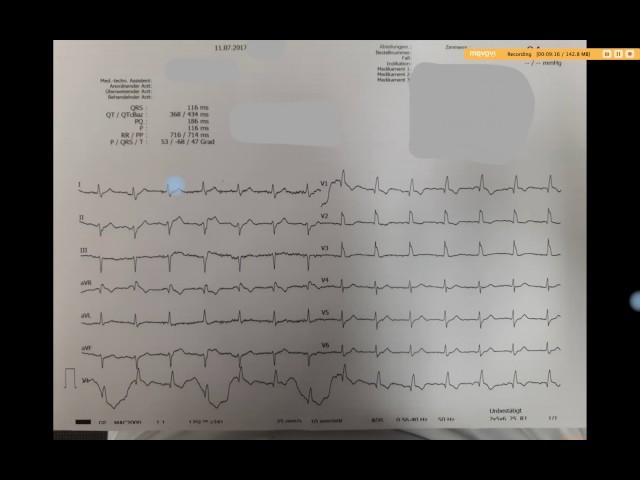 Ecg Shot z 11.07.2017