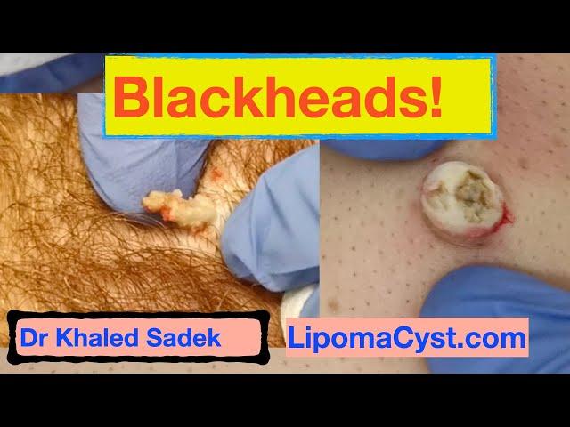 Dr Khaled Sadek. Blackhead Compilation. LipomaCyst.com