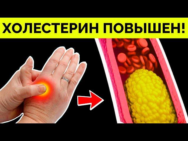Вот как обнаружить ВЫСОКИЙ ХОЛЕСТЕРИН! Методы снижения ХОЛЕСТЕРИНА